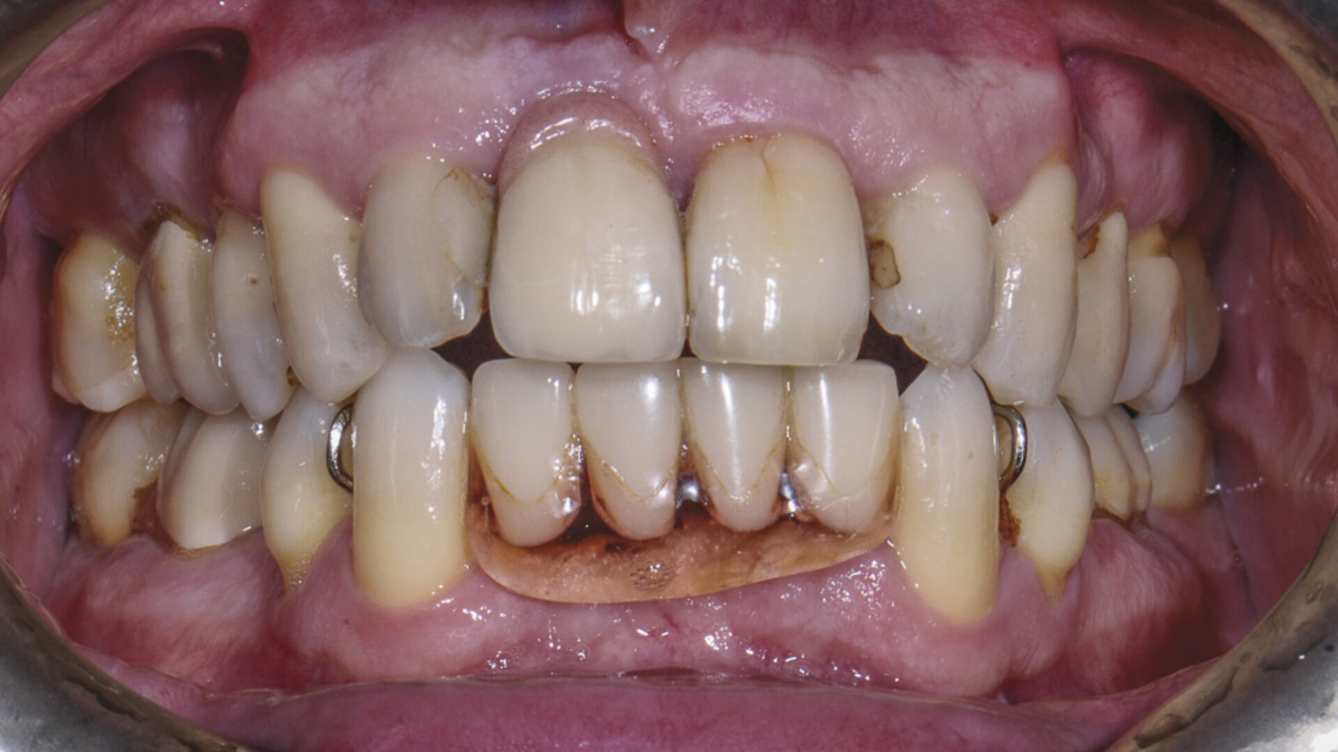 전체임플란트 전 전체임플란트 전