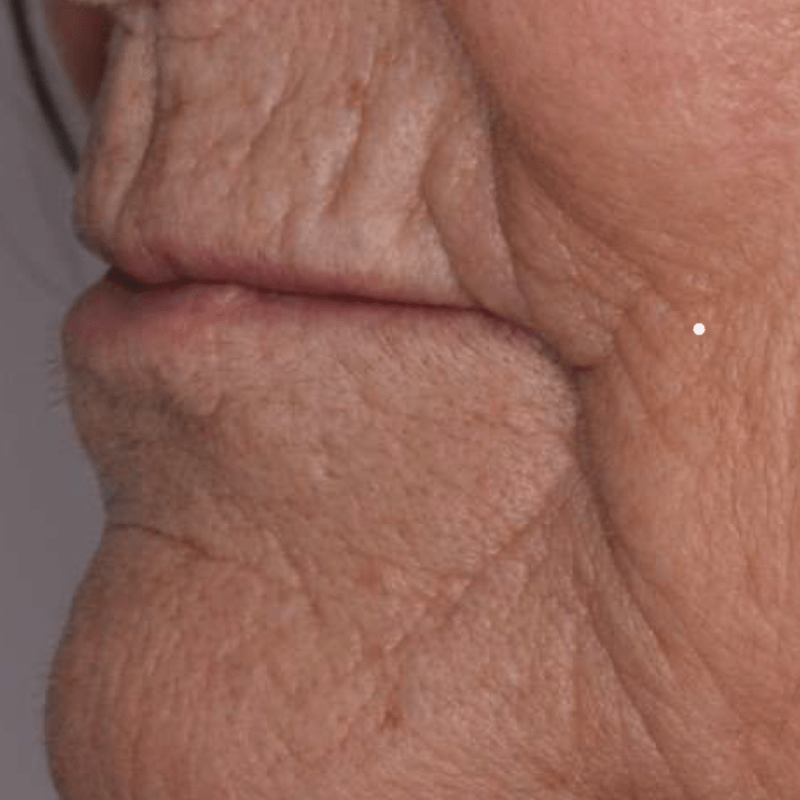 노원 무치악임플란트 치료